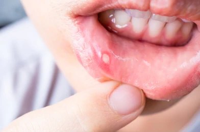 Mouth Sore